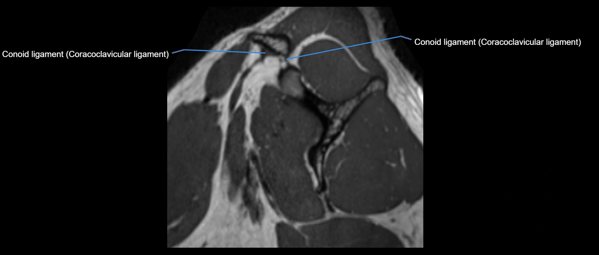 shoulder ligaments sagittal  cross sectional anatomy 3T MRI AI enhanced radiology image -img-00001-00012.webp